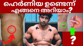 നിങ്ങൾക്ക് ഹെർണിയ ഉണ്ടോ Signs and Symptoms of a Hernia Malayalam  What is Hernia [upl. by Noremmac]