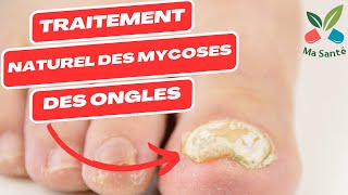 Traitement naturel des mycose  mycose pied  mycose ongle pied  mycose ongle main et les autres [upl. by Georgetta]