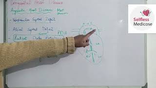 FCPS part 1CVS lecture 20 ACYANOTIC HEART DISEASES made easy [upl. by Wanonah876]