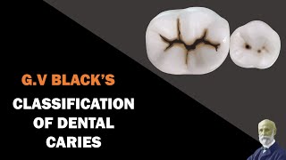 Classification of Dental Caries  GV Blacks Classification [upl. by Aniroz976]