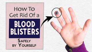 How to Get Rid of a Blood Blister Safely by Yourself [upl. by Deryl]