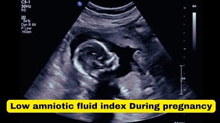 Low Amniotic Fluid Levels During Pregnancy Causes Concerns and Solutions [upl. by Min341]