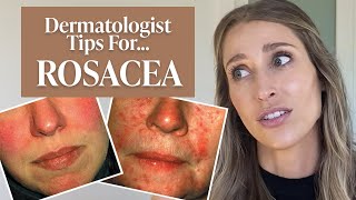 Dermatologist’s Guide to Rosacea What Is It Dos amp Don’ts Treatment Tips amp More  Dr Sam Ellis [upl. by Kerk]