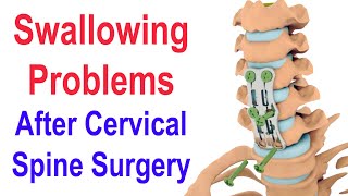 Swallowing Problems after Cervical Spine Surgery ACDF [upl. by Eerahc532]