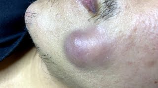 Big Pimples  Mụn Nhọt Siêu To  SacDepSpa158 [upl. by Flieger]