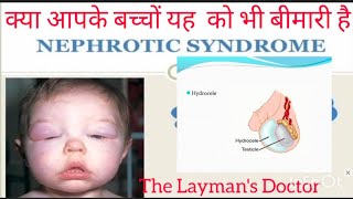 nephrotic syndrome नेफ्रोटिक सिंड्रोम क्या है  कैसा होता हैं [upl. by Efrem]