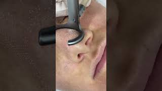 CO2 Fractional Laser is The Ultimate Skin Rejuvenation Treatment [upl. by Alleon657]