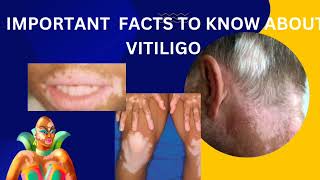 vitiligopart2diagnosis and latest treatment about opzelura creamskinhealthvitality5959 [upl. by Atinid]