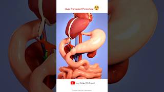 Liver transplant Procedure Animation Video [upl. by Darees]