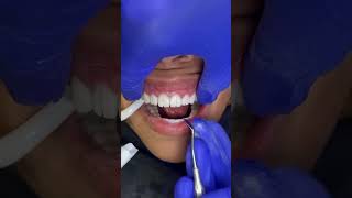 Breaking away temporary smile on revision case dentist dentistry veneers [upl. by Choong]