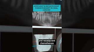 Adjuvant vs NeoAdjuvant Chemotherapy in Oral Cancer Making the Right Choice 🦷👩‍⚕️🎗️ [upl. by Caiaphas]