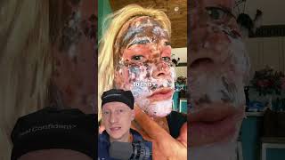 SHOCKING CO2 Laser Recovery Is Normal  Plastic Surgeon Reacts [upl. by Hait797]