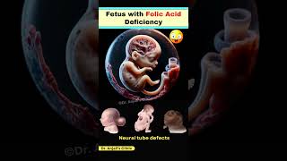 How Folic Acid Deficiency Leads to Neural Tube Defects in Pregnancy shortsviral pregnancy vitamin [upl. by Zobias]