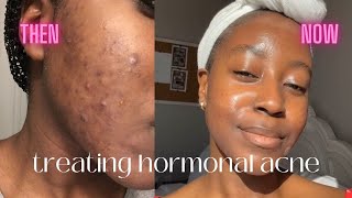 Comprehensive Guide to Managing Hormonal Acne  Lakisha Adams [upl. by Brandtr]