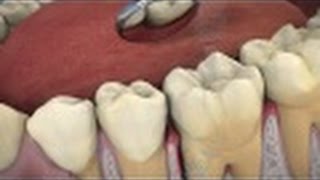 The Role of ARESTIN® in Periodontal Treatment [upl. by Alyakam]