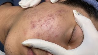 ACNE TREATMENT VU QUYNH MI  Blackheads On Boy Face 2024FULL [upl. by Minta56]