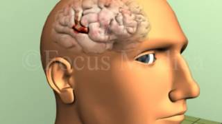 Frontal eye field lesions  Neuroanatomy [upl. by Nyrual]