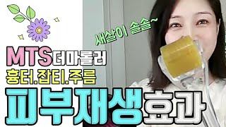 ◇거꾸로가는시계 MTS시술 실전편주름제거잡티제거흉터제거피부탄력◇korea madam model [upl. by Cirda]