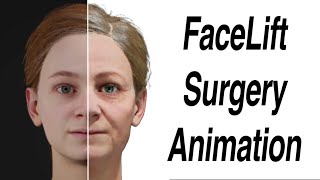 FaceLift Surgery Animation [upl. by Einaffets]