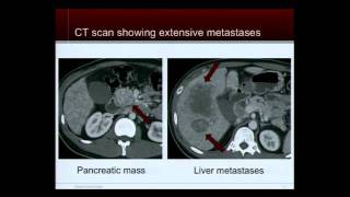 Tumor Board Case Discussions Neuroendocrine Tumor Patient Education Conference [upl. by Charmain]