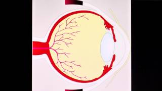 Diabetische Retinopathie [upl. by Hobbie]