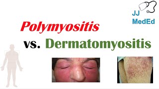 Idiopathic Inflammatory Myopathies  Polymyositis vs Dermatomyositis [upl. by Box107]