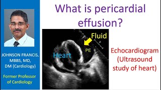 Cardiac tamponade Part 2 Detecting and differentiating pericardial effusion from pleural effusion [upl. by Anirbed110]