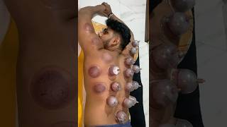 CUPPING THERAPY odiasong viralvideo [upl. by Burnett]