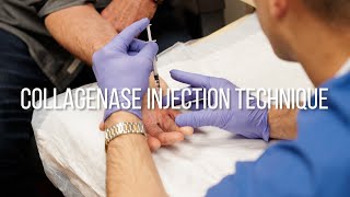 Collagenase Injection Technique for Dupuytrens Contracture [upl. by Siahc]