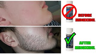 Growing a Beard from Nothing  Minoxidil Beard Transformation  Full 2020 Timeline [upl. by Anaidiriv]