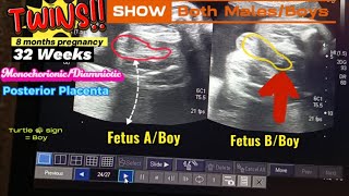 32 Weeks Twins  Boy  Boy  Both Male Fetus  Turtle 🐢 sign  Posterior Placenta  Ultrasound [upl. by Ayanat646]