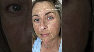 Melasma Can Be Cured With Hydroquinone Dermatologist Explains [upl. by Ahcatan]