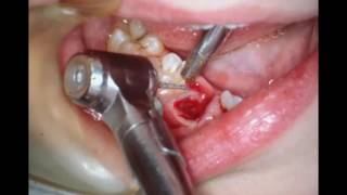 Orthodontic Slicing of decidious teeth with pulpotomy [upl. by Livvyy994]