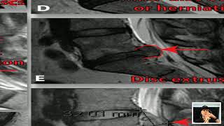 Spine MRI Explained In Plain English [upl. by Oona]