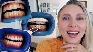 IS IT WORTH IT Professional teeth whitening BEFORE amp AFTER [upl. by Wallack]