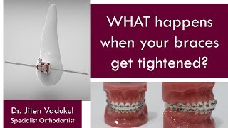 WHAT happens when your braces get tightened  Dr Jiten Vadukul  The Orthodontist [upl. by Neely]