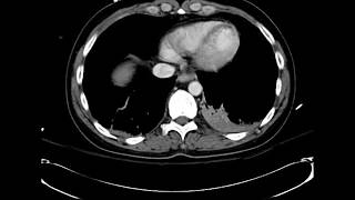 What is your diagnosis Myocardial infarct on Chest CT [upl. by Zelda]