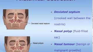 The Pathophysiology of Rhinosinusitis [upl. by Enined]