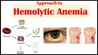 Approach to hemolytic anaemiapathology pathologylab hematology smear anaemia hemepath [upl. by Sybilla]