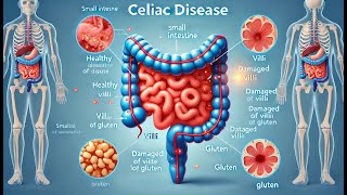 Celiac Disease Gut Health Explained  Modern Medicine [upl. by Htaeh323]