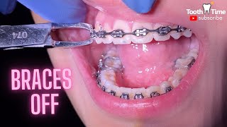 Braces off  What happens when you get your braces off  Tooth Time Family Dentistry New Braunfels [upl. by Alidus]