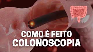 Como é o exame de colonoscopia MOSTRANDO TUDO [upl. by Ziom]