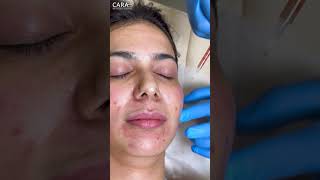 Understanding PRP Treatment at Cara Clinic Mumbai [upl. by Euqor]