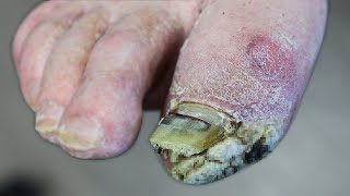 WHATS GROWING ON HIS FOOT THICK SKIN OR FUNGUS [upl. by Ronoel]