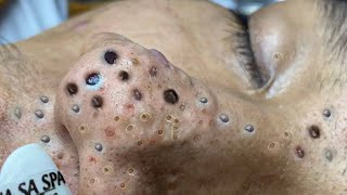 Big Cystic Acne Blackheads Extraction Blackheads amp Milia Whiteheads Removal Pimple Popping  2623 [upl. by Shien575]