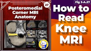 Fig 3A27 Posteromedial Corner MRI Anatomy Posterior Oblique Ligament [upl. by Agarhs564]