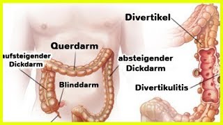 Divertikulitis und Divertikulose – Was ist das und welche Behandlungen gibt es [upl. by Nail960]