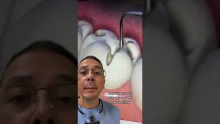 How Does a Dentist Fill a Cavity  View Mobile Dental [upl. by Veator475]