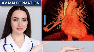 Radiographic Features of Arteriovenous Malformation [upl. by Anelrats]