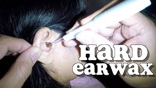 Womans Hard Earwax Removed with Few Drops of Hydrogen Peroxide [upl. by Assenev]